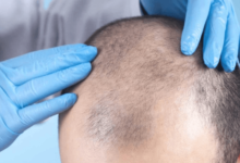 hair loss specialist Toronto