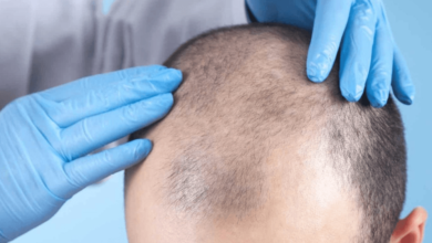 hair loss specialist Toronto