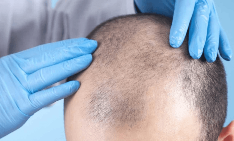 hair loss specialist Toronto